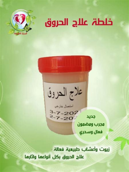 خلطة علاج الحروق